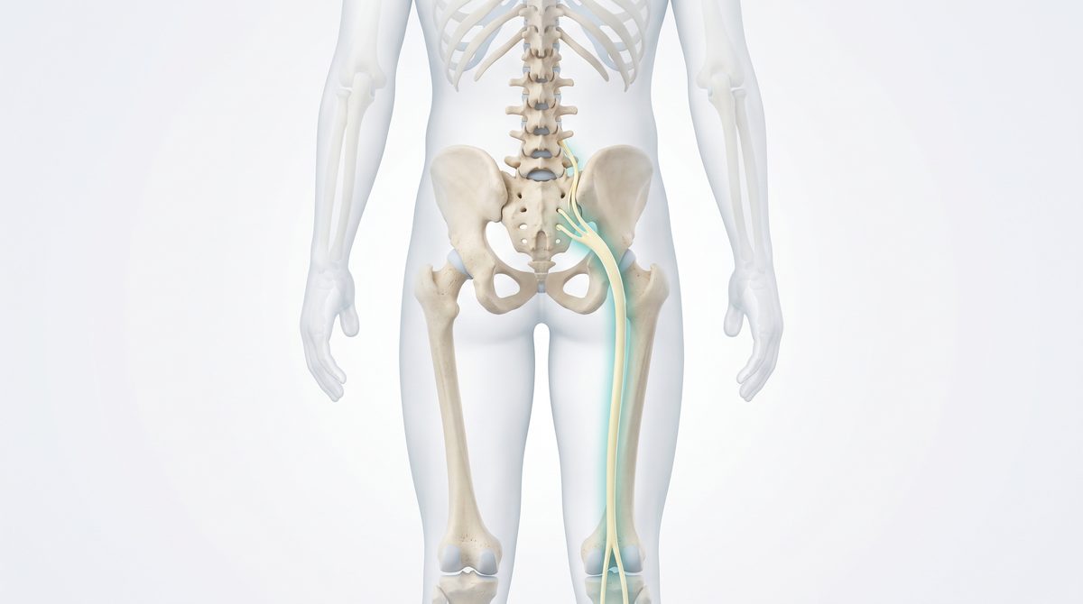 Illustration of the sciatic nerve running from the lower spine down the back of one thigh